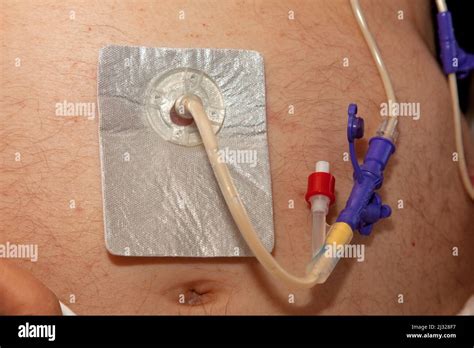 pegogram|Percutaneous Endoscopic Gastrostomy: PEG Tube Feeding,。